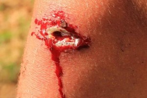 Первая помощь при ранениях Первая помощь при ранениях