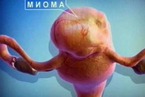 Миома Миома