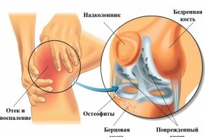 Существующие заболевания суставов