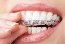 Преимущества системы позиционирования смещенных зубов Invisalign 